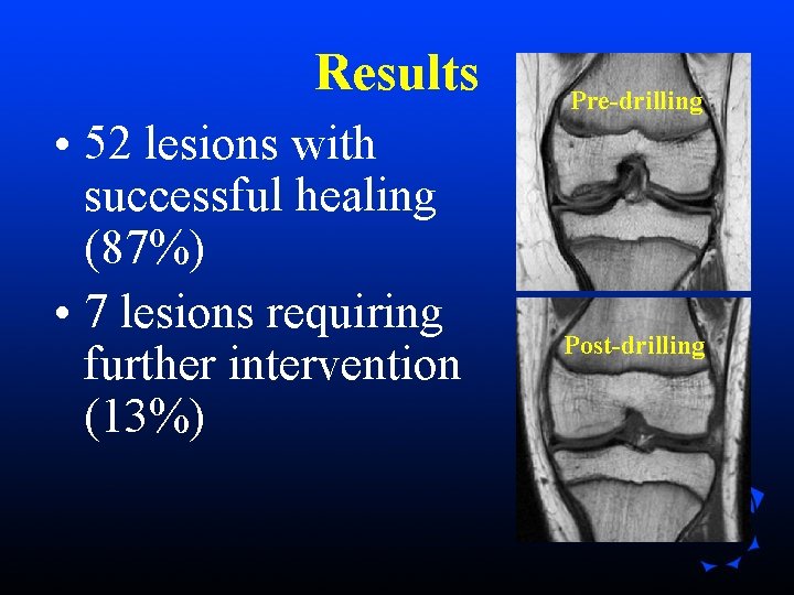 Results • 52 lesions with successful healing (87%) • 7 lesions requiring further intervention Results • 52 lesions with successful healing (87%) • 7 lesions requiring further intervention