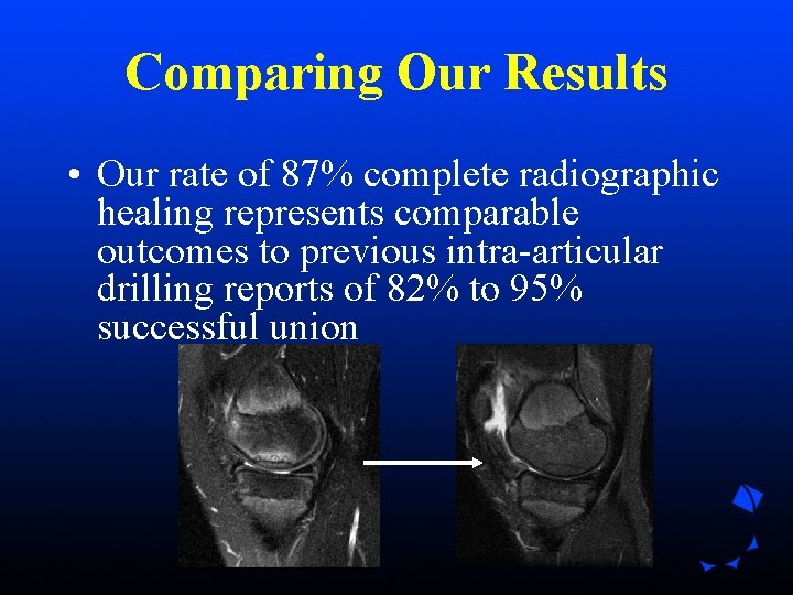 Comparing Our Results • Our rate of 87% complete radiographic healing represents comparable outcomes Comparing Our Results • Our rate of 87% complete radiographic healing represents comparable outcomes