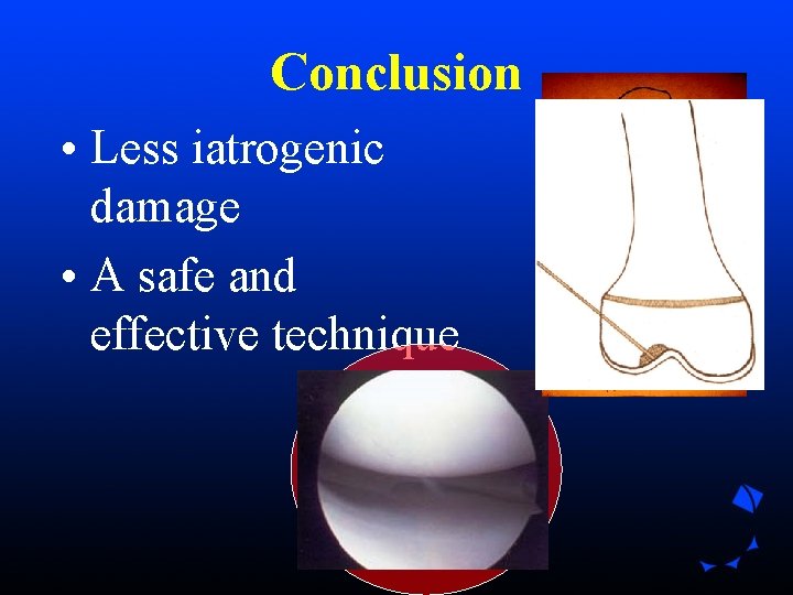 Conclusion • Less iatrogenic damage • A safe and effective technique Conclusion • Less iatrogenic damage • A safe and effective technique