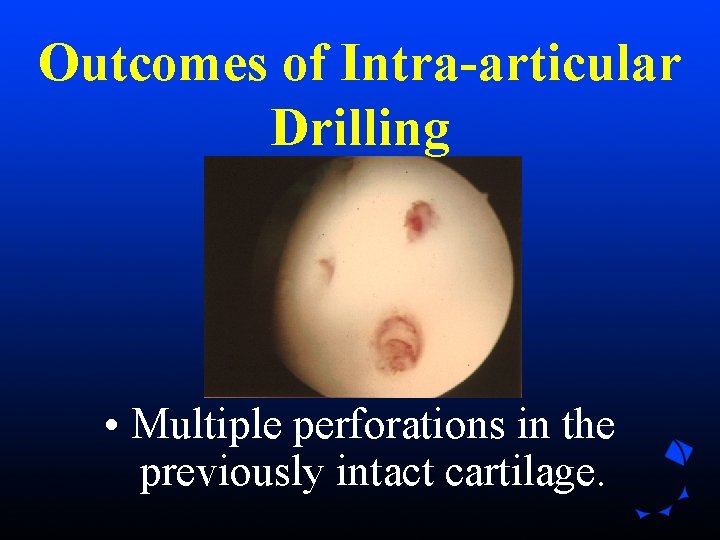 Outcomes of Intra-articular Drilling • Multiple perforations in the previously intact cartilage. Outcomes of Intra-articular Drilling • Multiple perforations in the previously intact cartilage.