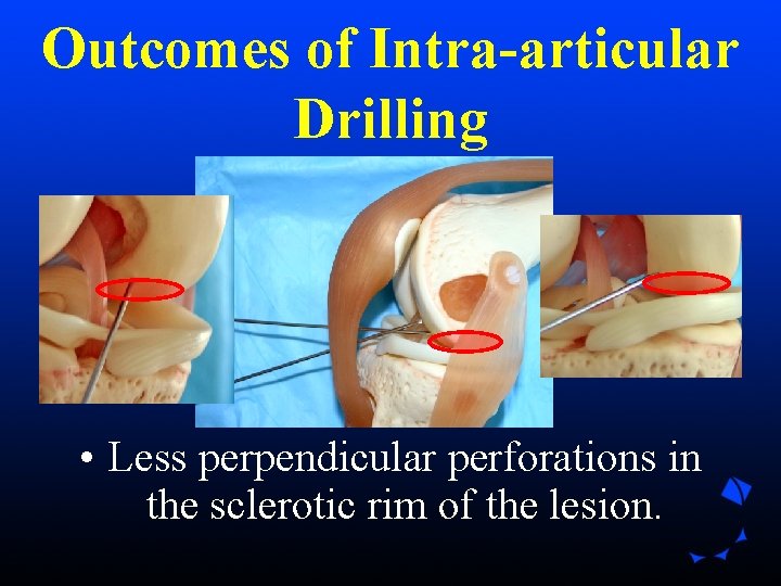 Outcomes of Intra-articular Drilling • Less perpendicular perforations in the sclerotic rim of the Outcomes of Intra-articular Drilling • Less perpendicular perforations in the sclerotic rim of the