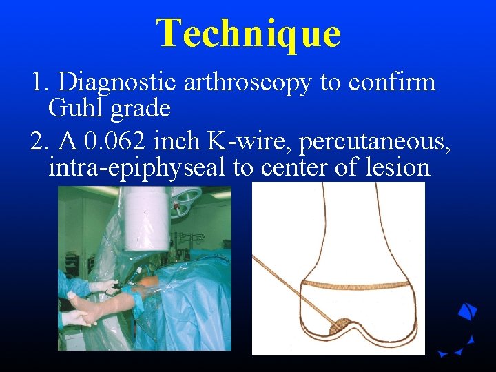 Technique 1. Diagnostic arthroscopy to confirm Guhl grade 2. A 0. 062 inch K-wire, Technique 1. Diagnostic arthroscopy to confirm Guhl grade 2. A 0. 062 inch K-wire,
