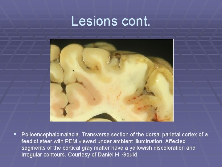 Lesions cont. § Polioencephalomalacia. Transverse section of the dorsal parietal cortex of a feedlot