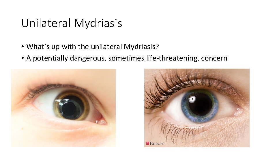 Unilateral Mydriasis • What’s up with the unilateral Mydriasis? • A potentially dangerous, sometimes