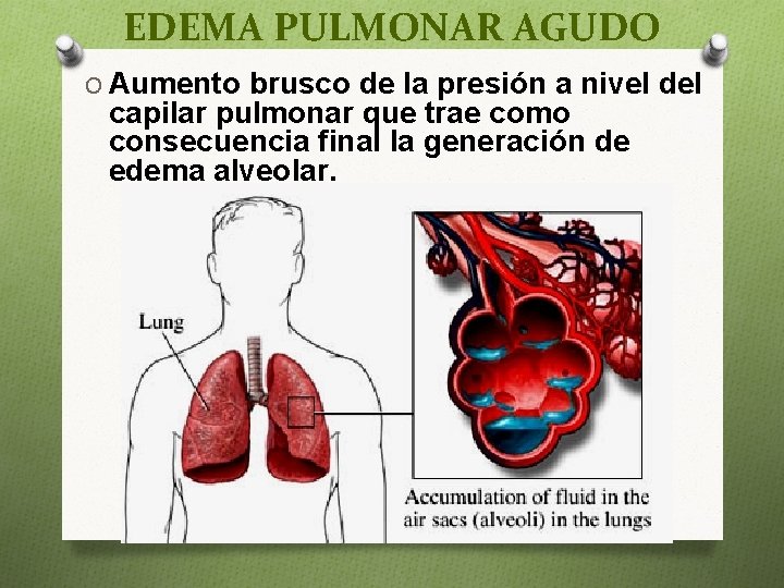 EDEMA PULMONAR AGUDO O Aumento brusco de la presión a nivel del capilar pulmonar