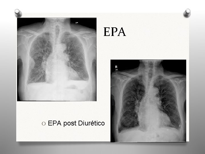 EPA O EPA post Diurético 27 