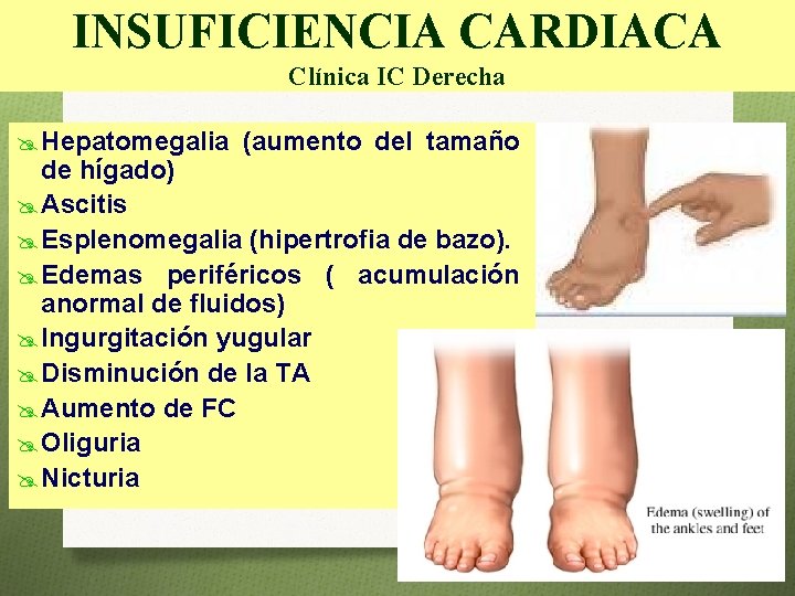 INSUFICIENCIA CARDIACA Clínica IC Derecha @ Hepatomegalia (aumento del tamaño de hígado) @ Ascitis