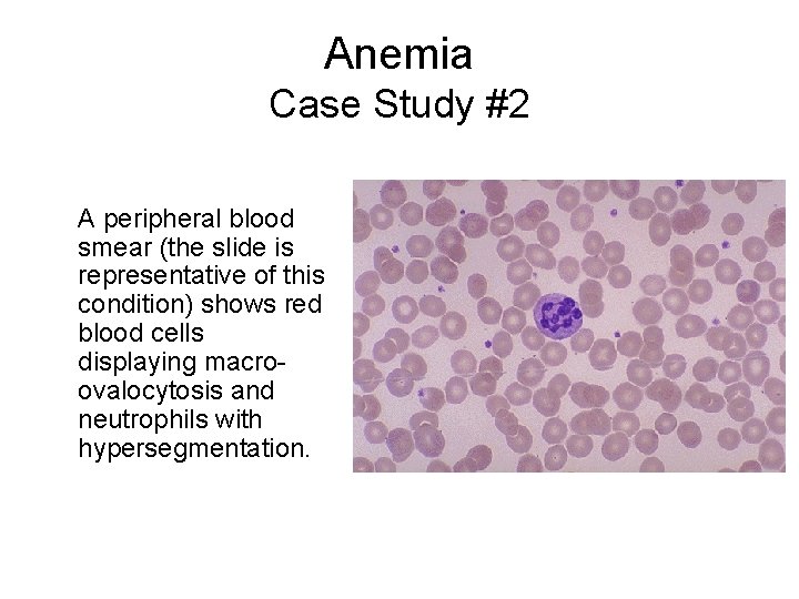 Anemia Case Study #2 A peripheral blood smear (the slide is representative of this