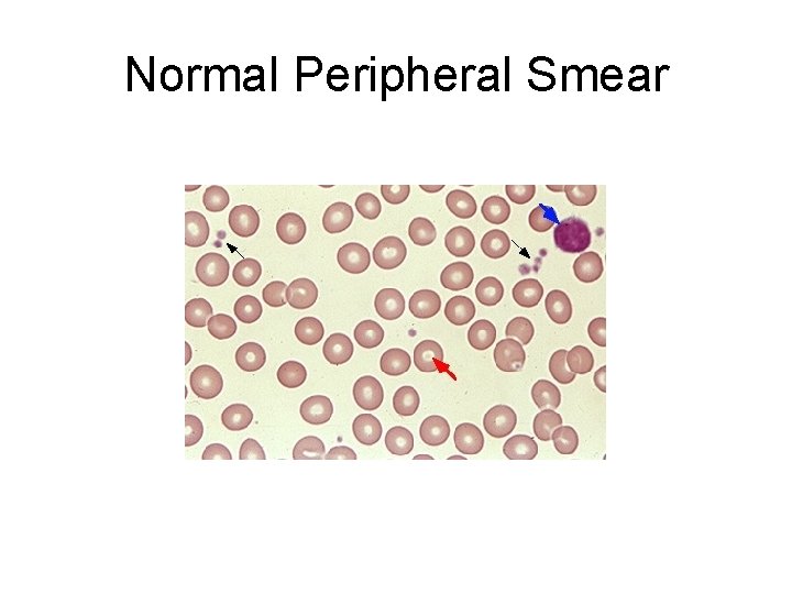 Normal Peripheral Smear 