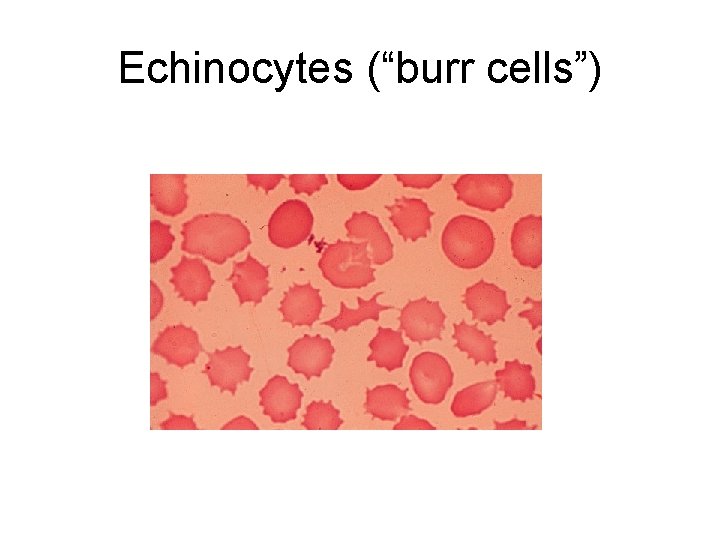 Echinocytes (“burr cells”) 