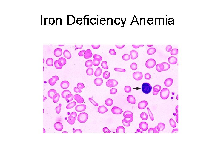 Iron Deficiency Anemia 