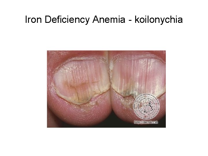 Iron Deficiency Anemia - koilonychia 