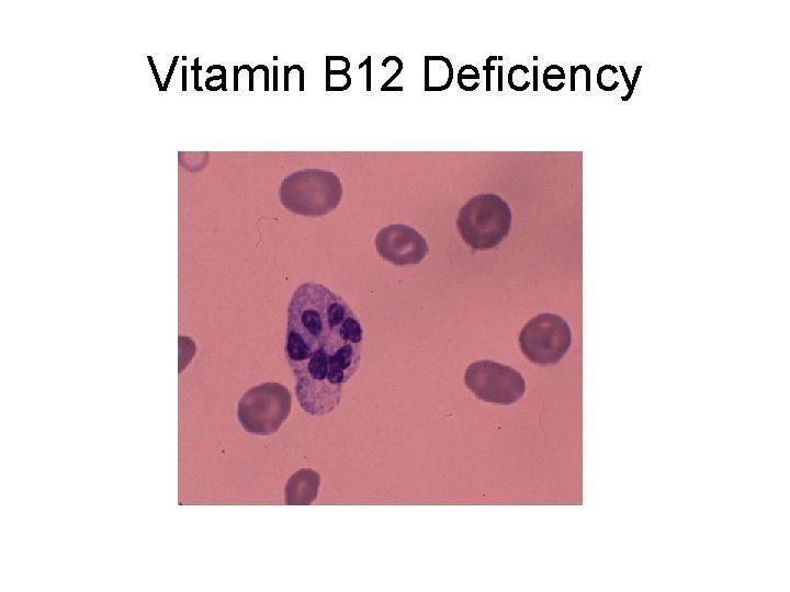 Vitamin B 12 Deficiency 