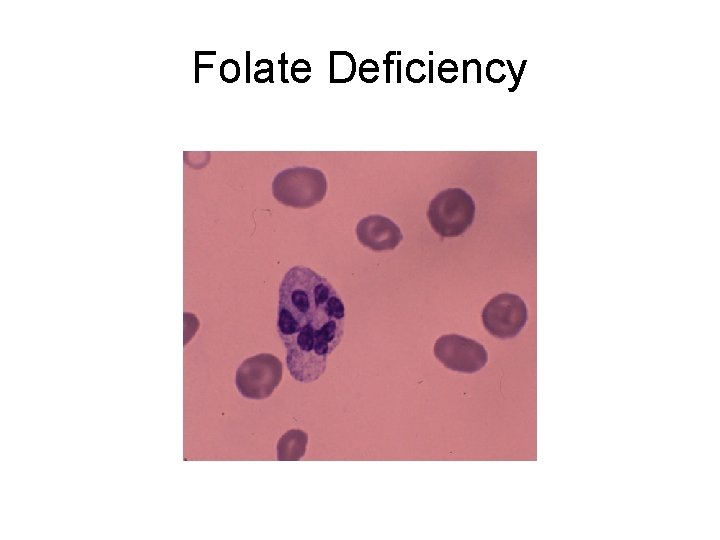 Folate Deficiency 