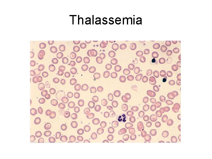 Thalassemia 