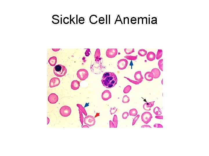 Sickle Cell Anemia 