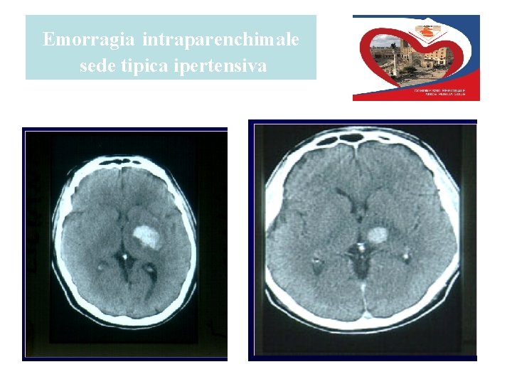 Emorragia intraparenchimale sede tipica ipertensiva 