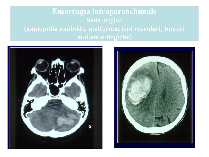 Emorragia intraparenchimale Sede atipica (angiopatia amiloide, malformazioni vascolari, tumori mal. ematologiche) 