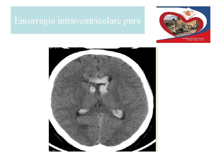 Emorragia intraventricolare pura 