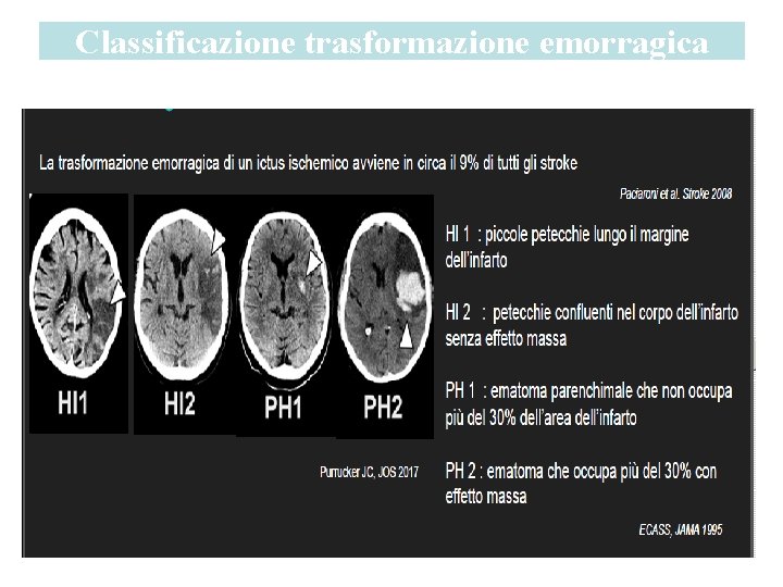 Classificazione trasformazione emorragica 