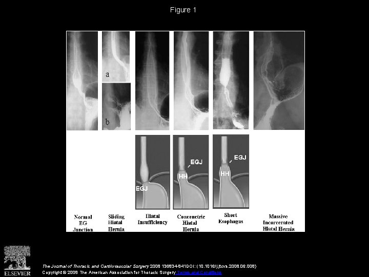 Figure 1 The Journal of Thoracic and Cardiovascular Surgery 2008 136834 -841 DOI: (10.