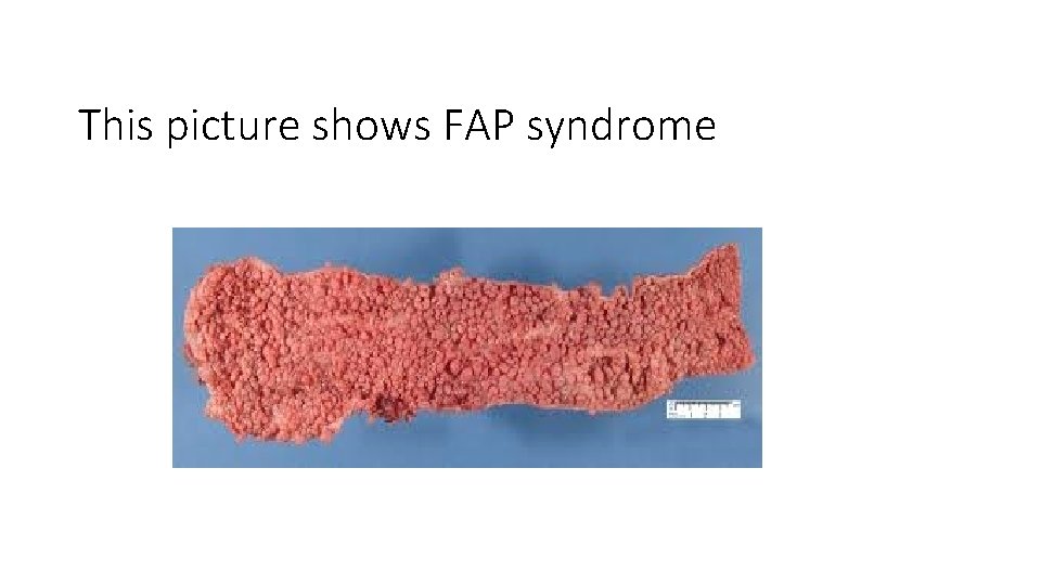 This picture shows FAP syndrome 