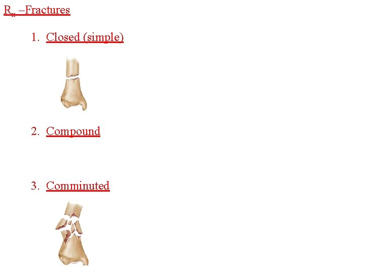 Rx –Fractures 1. Closed (simple) 2. Compound 3. Comminuted 