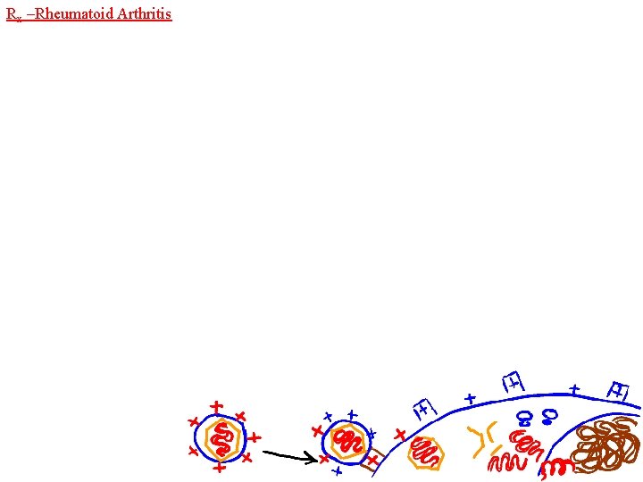 Rx –Rheumatoid Arthritis 