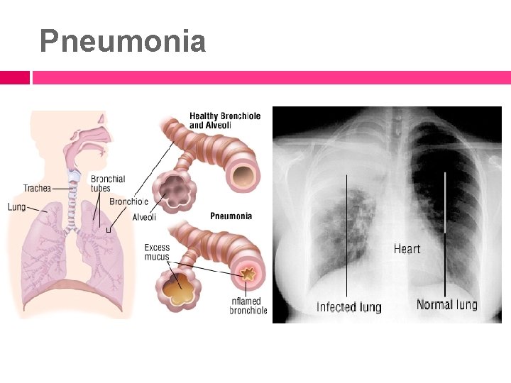 Pneumonia 