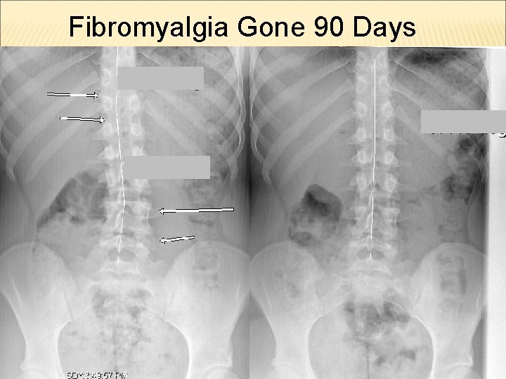 Fibromyalgia Gone 90 Days 