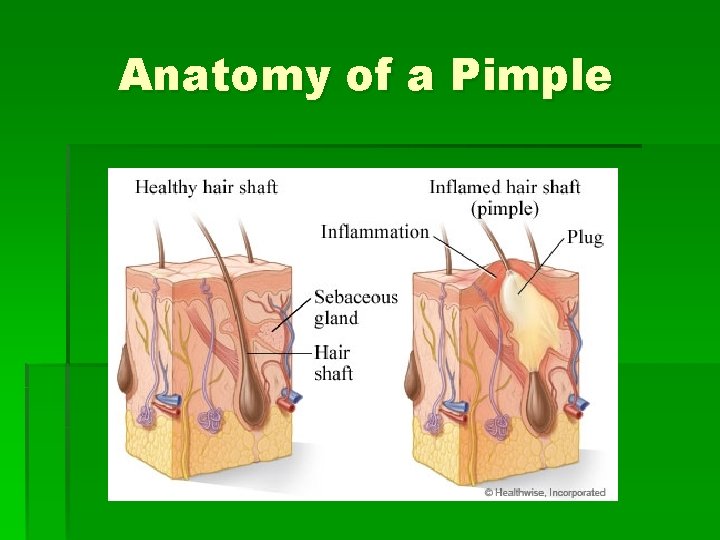 Anatomy of a Pimple 