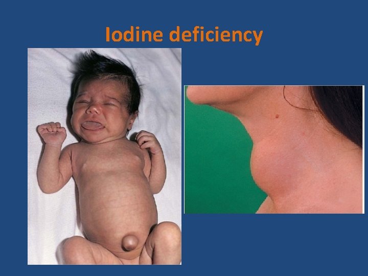 Iodine deficiency 