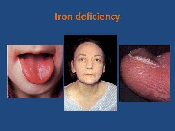 Iron deficiency 