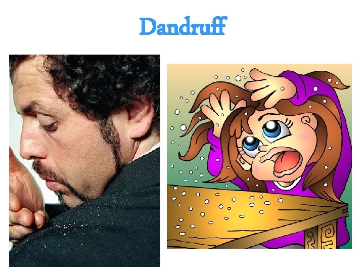 Dandruff 