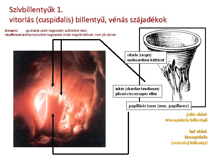 Szívbillentyűk 1. vitorlás (cuspidalis) billentyű, vénás szájadékok Stenosis: gyulladás utáni hegesedés szűkületet okoz Insufficientia: