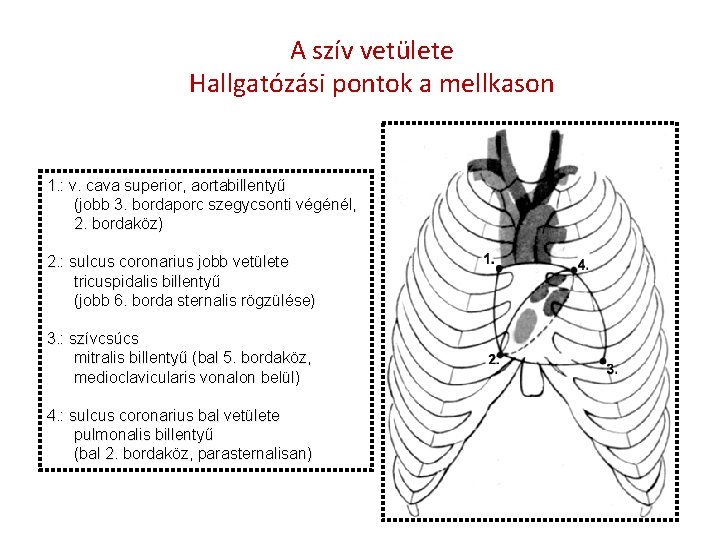 A szív vetülete Hallgatózási pontok a mellkason 1. : v. cava superior, aortabillentyű (jobb