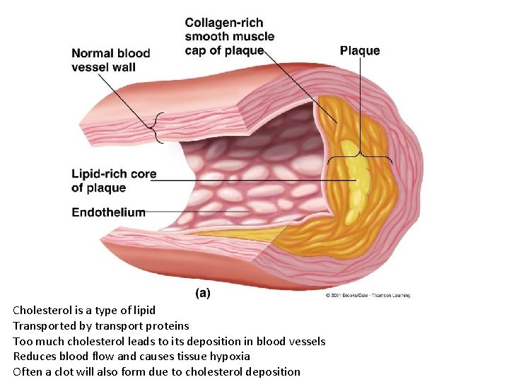 Cholesterol is a type of lipid Transported by transport proteins Too much cholesterol leads