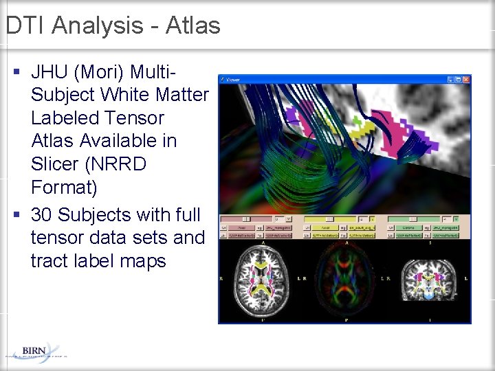 Tensor Atlas Morphometry BIRN Analysis Visualization and Interpretation