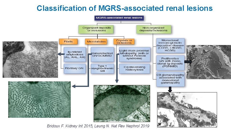 Classification of MGRS-associated renal lesions Bridoux F. Kidney Int 2015, Leung N. Nat Rev