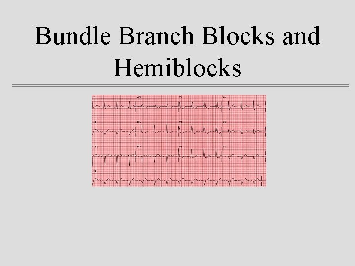 Bundle Branch Blocks and Hemiblocks 