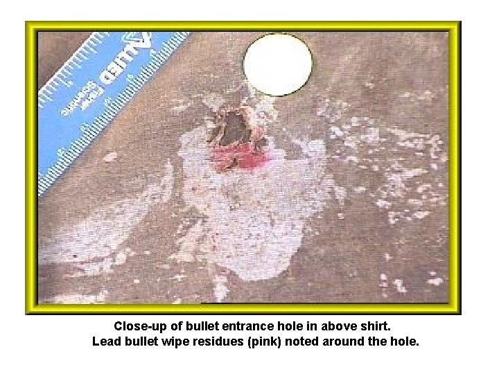 Close-up of bullet entrance hole in above shirt. Lead bullet wipe residues (pink) noted