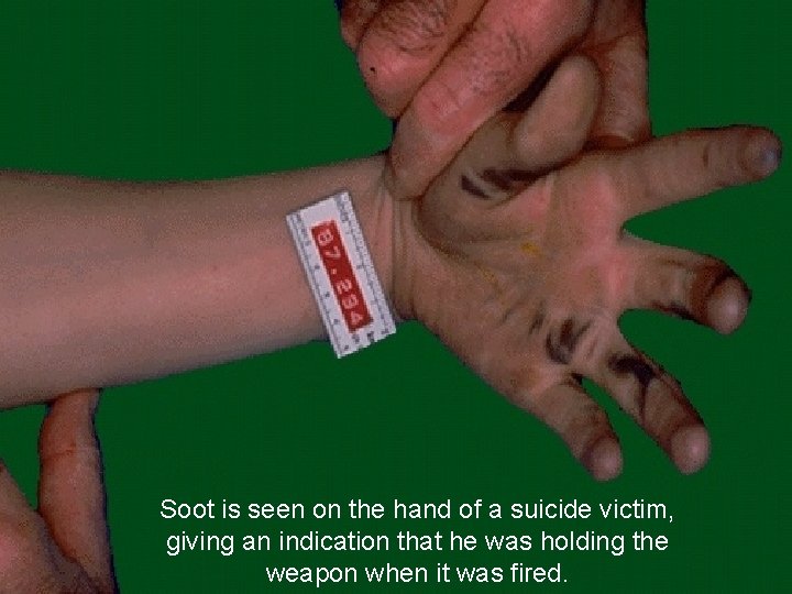 Soot is seen on the hand of a suicide victim, giving an indication that