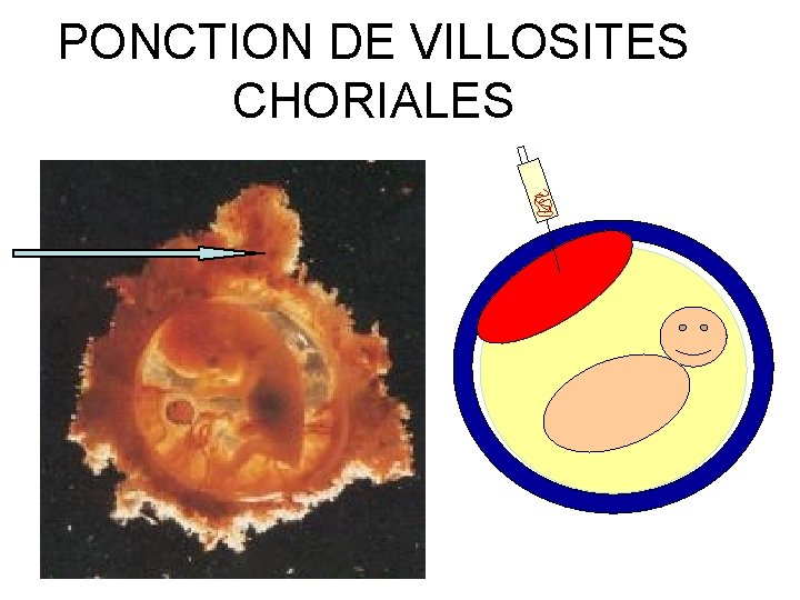 PONCTION DE VILLOSITES CHORIALES 