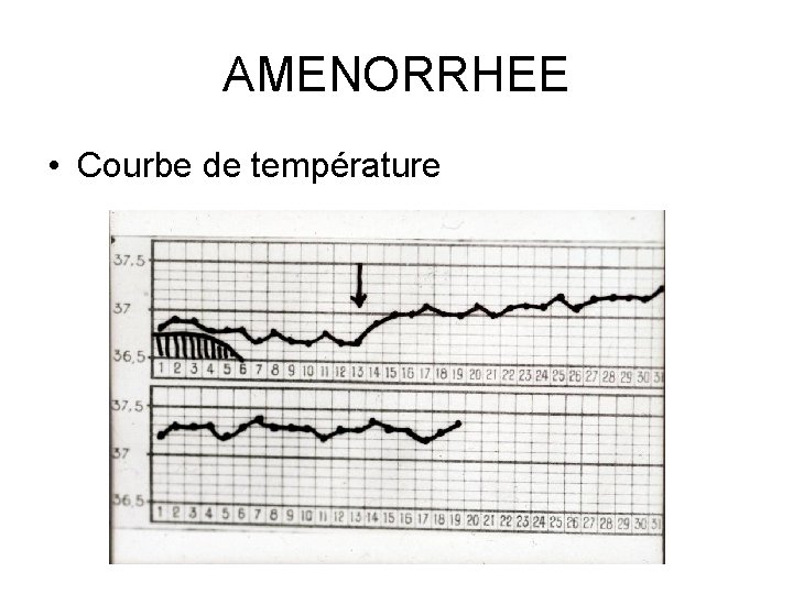 AMENORRHEE • Courbe de température 