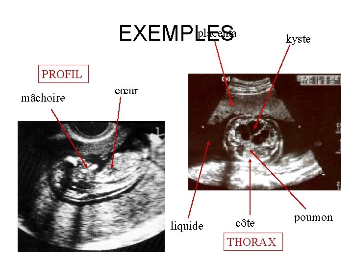 placenta EXEMPLES kyste PROFIL mâchoire cœur liquide côte THORAX poumon 