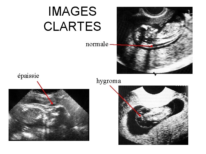 IMAGES CLARTES normale épaissie hygroma 