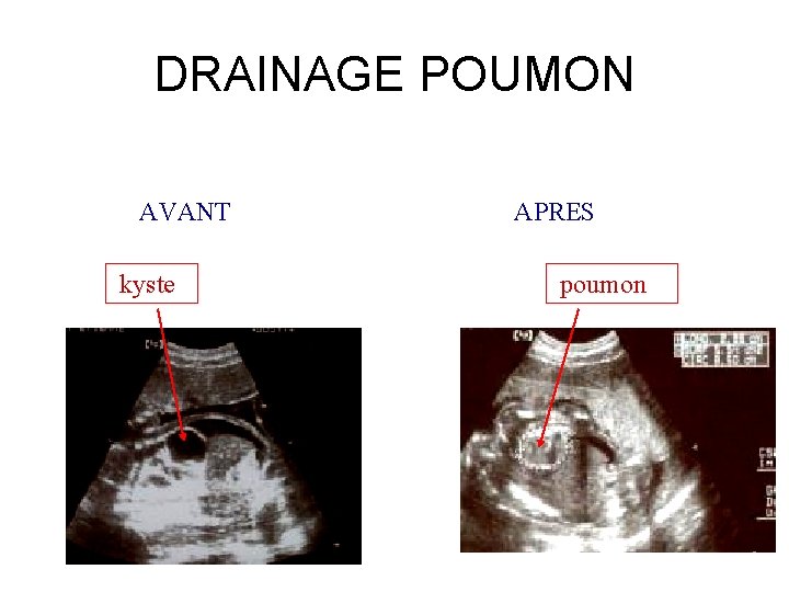 DRAINAGE POUMON AVANT kyste APRES poumon 