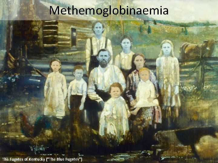 Methemoglobinaemia The Fugates of Kentucky (“The Blue Fugates”) 