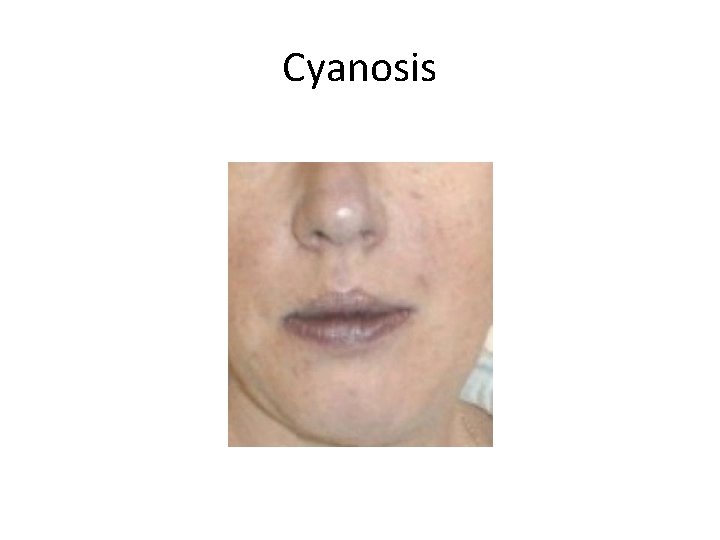 Cyanosis 