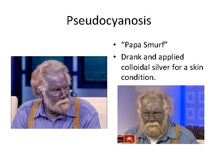 Pseudocyanosis • “Papa Smurf” • Drank and applied colloidal silver for a skin condition.